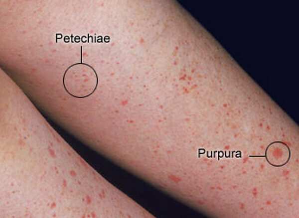 Petechiae