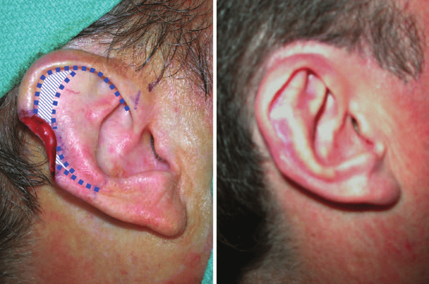 Helical advancement flap (antia buch reconstruction)