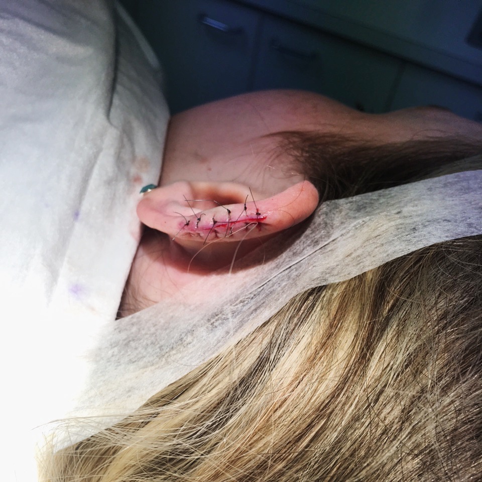 My friend Libby took this straight after the dermatologist cut the mole off, think I would have passed out if I had to watch it 😱