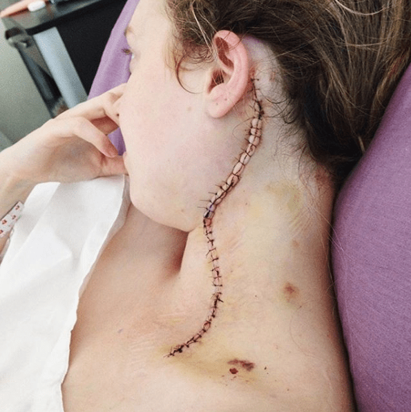 Modified radical neck dissection photo