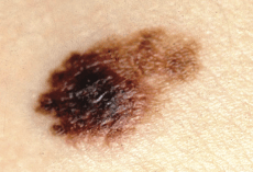 MelanomaPic2