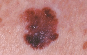 MelanomaPic4